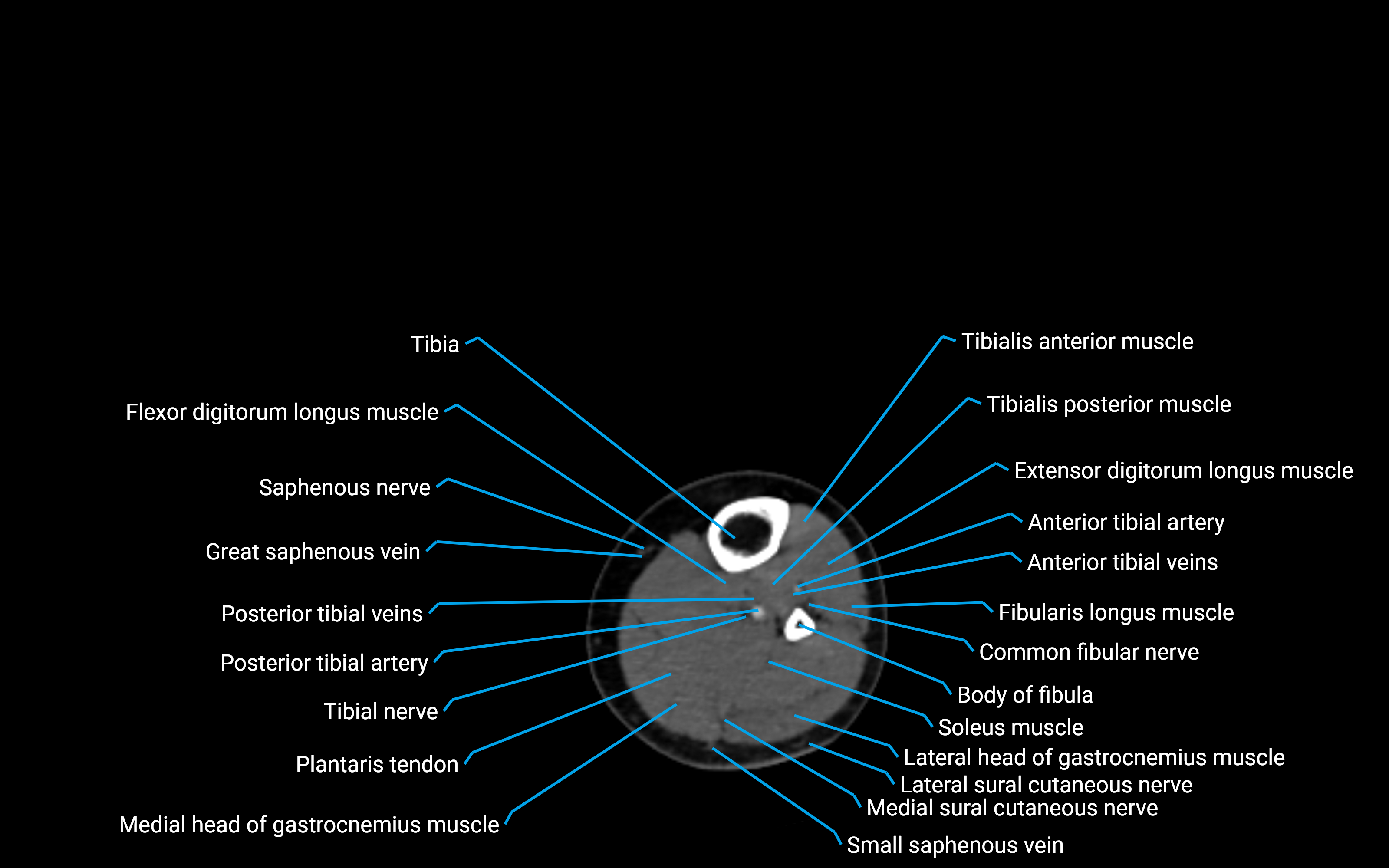 CT Lower leg axial cross sectional anatomy labelled image 107 (2).png